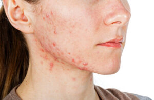 mujer con problemas de acné